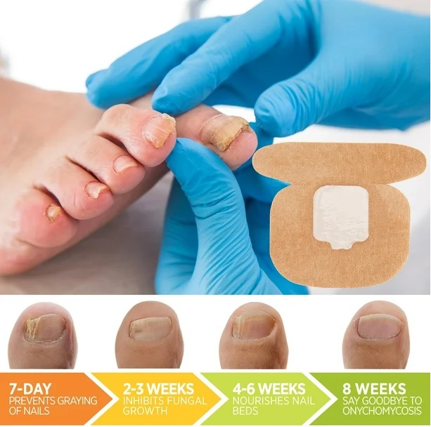 Pack Parches Antihongos Pies Azul x2 - Reparación Uñas Dañadas - Imagen 2