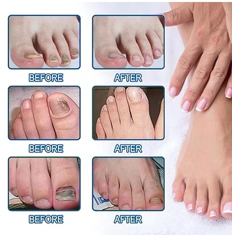 Pack Parches Antihongos Pies Azul x2 - Reparación Uñas Dañadas - Imagen 3